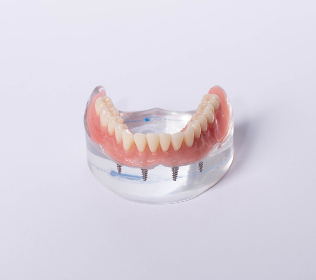 Brentwood All-on-4®