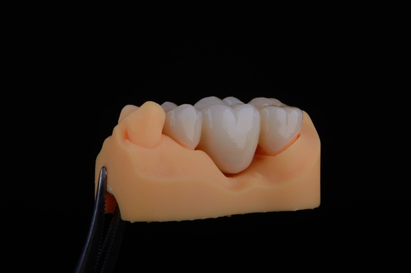 Dental Bridge Failure: What It Is And How To Avoid It